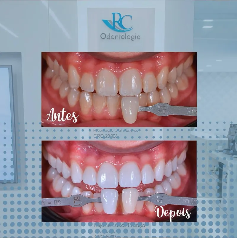 Antes e depois de clareamento dentário — caso real documentado pela RC Odontologia com logo e crédito CRO